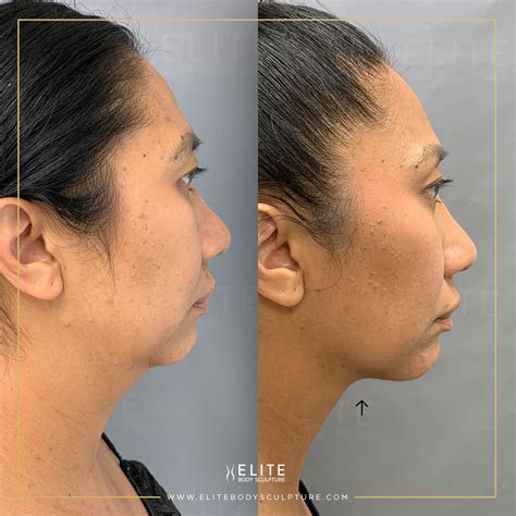 chin airsculpt near me