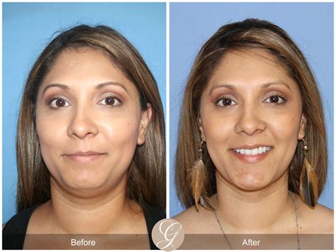 chin implant and neck liposuction