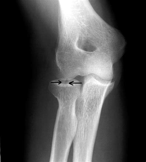 Chisel Fracture Radial Head