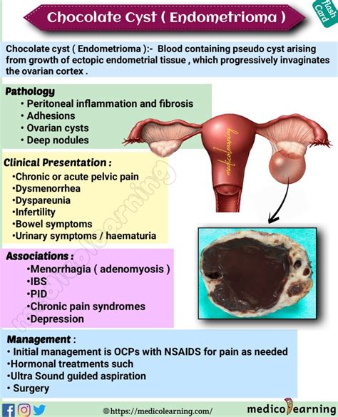 chocolate cyst of ovary