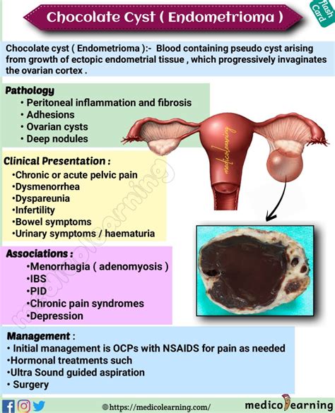 chocolate cyst of ovary symptoms