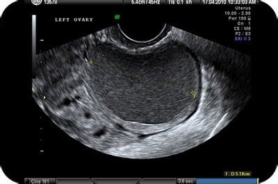chocolate cyst ovary ultrasound