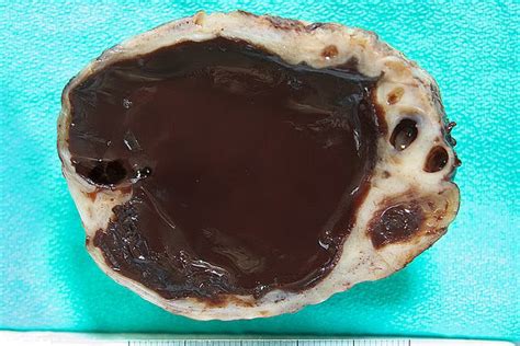 chocolate tumor on ovary