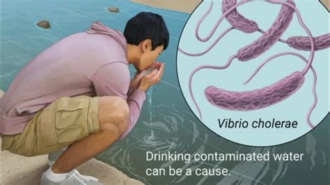 cholera due to vibrio cholerae