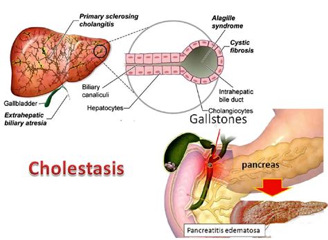 Cholestasis Liver