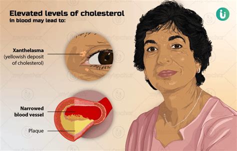 High Cholesterol Symptoms in Hindi कोलेस्ट्रॉल बढ़ने के