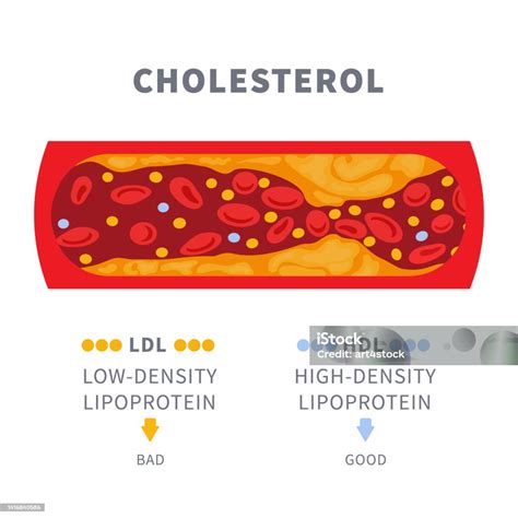 Cholesterol Buildup