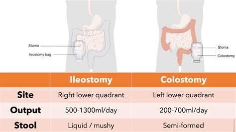 Cholestyramine Ileostomy
