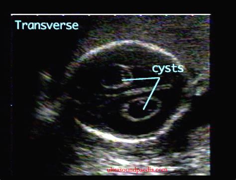 Understanding Choroid Plexus Cysts: Causes, Symptoms, and What You Need to Know