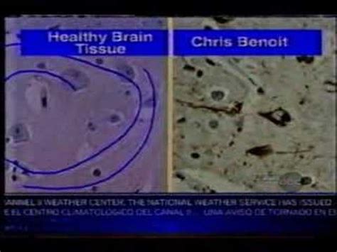 chris benoit brain autopsy