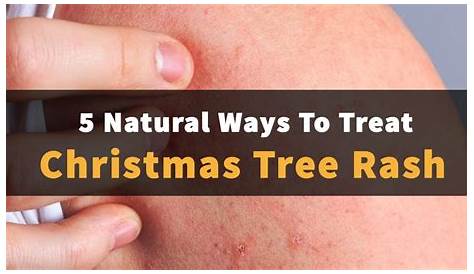 Christmas Tree Rash Photos Pityriasis Rosea Skin Distribution Plaque