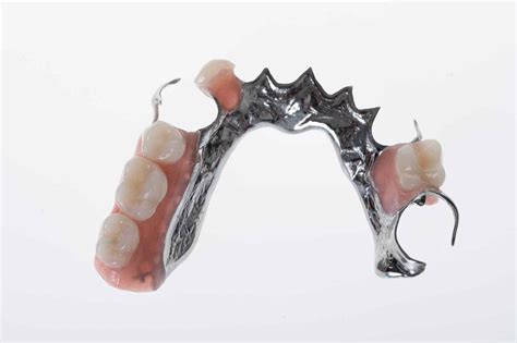 Chrome Partial Denture Design