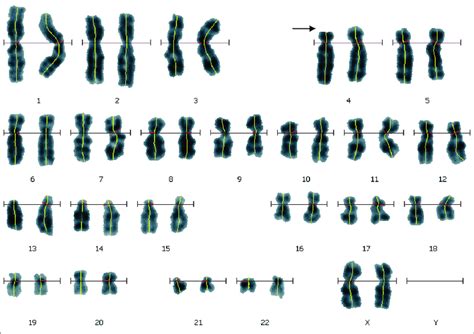 chromosome 4 deletion prognosis