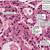 chronic cholecystitis histology of the liver