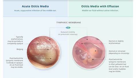 Chronic Otitis Media Symptoms In Adults Pin On Health