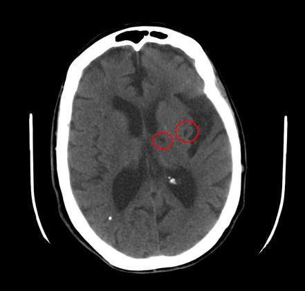 chronic appearing lacunar infarct