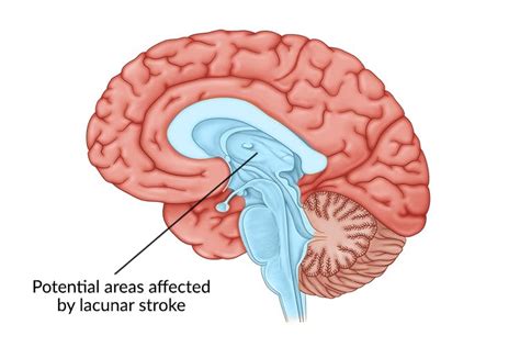 chronic lacunar infarct meaning