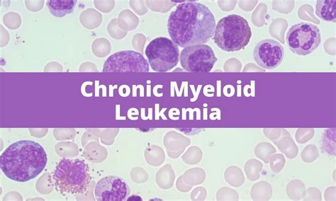 chronic myeloid