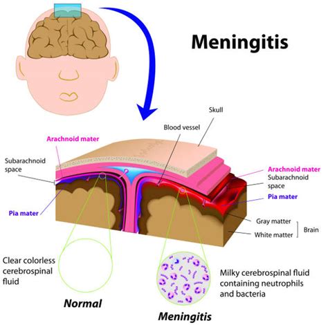 chronic viral meningitis