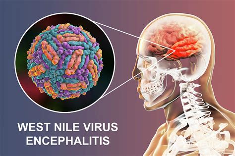 chronic west nile virus