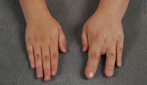 Chubby Fingers Meaning Fat When Hiking? Easy Tip To Stop Hands Swelling