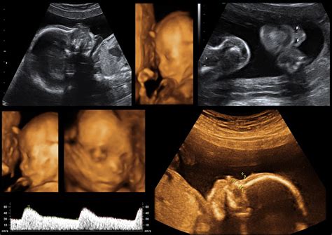 ci in pregnancy scan