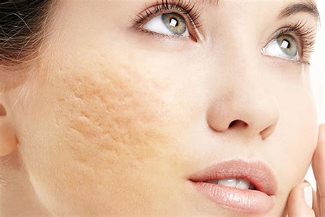 cicatriz de acne