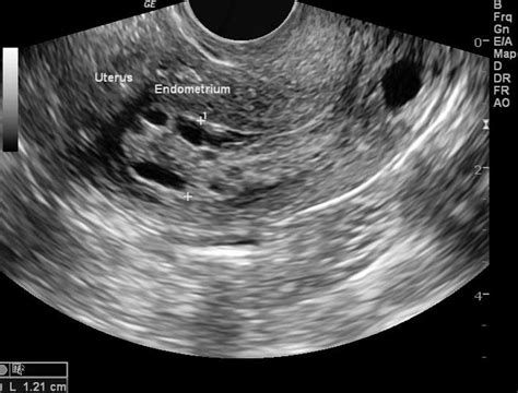 cid 10 trauma endometrial