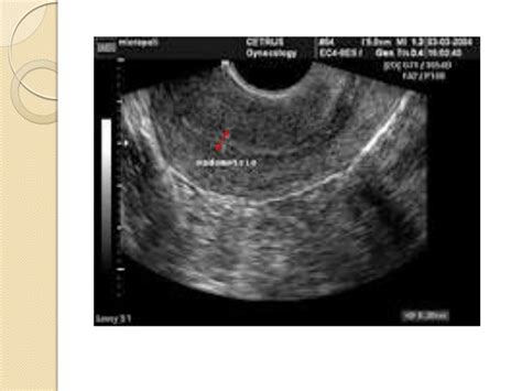 cid de espessamento endometrial