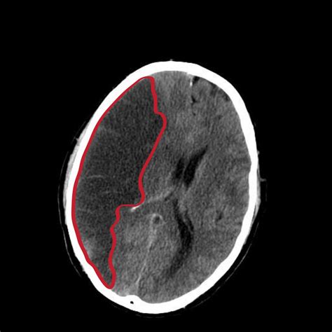 cid i63 - infarto cerebral