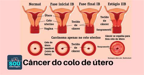 cid tumor de colo uterino