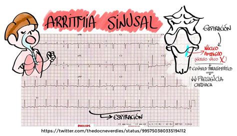 cie 10 arritmia sinusal