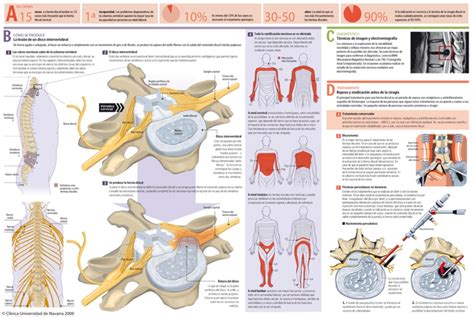 cie 10 de hernia lumbar