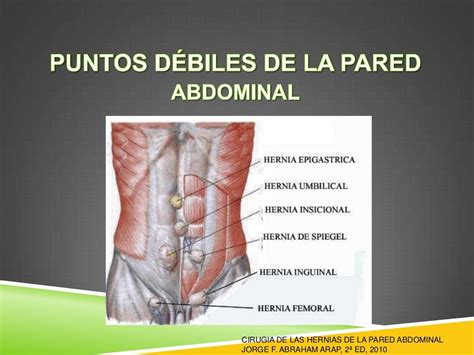 cie 10 hernia abdominal