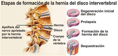 cie 10 hernia discal