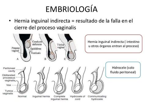 cie 10 hernia inguinoescrotal