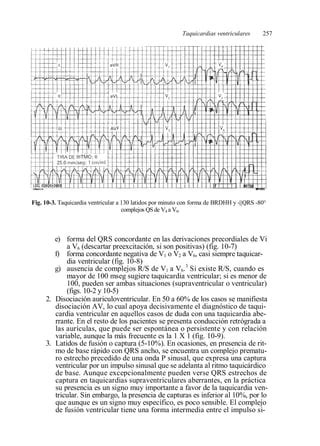 cie 10 taquicardia ventricular