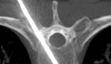 OSTEOPLASTIE ET OSTEOSYNTHESE SOUS GUIDAGE SCANNER