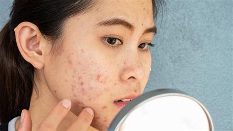 CiriCiri Purging Pada Wajah Setelah Menggunakan Skincare