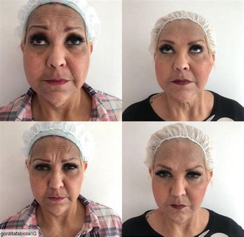 cirugia de cara antes y despues