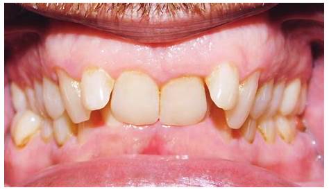 Class 2 Division 2 Occlusion - sharedoc