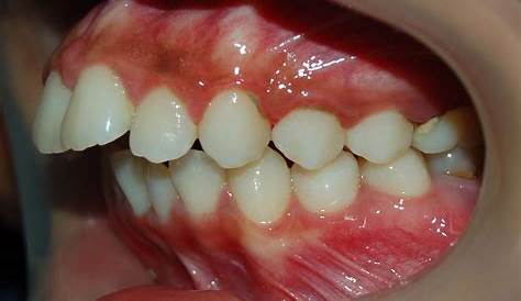 Class II Division 1 Malocclusion