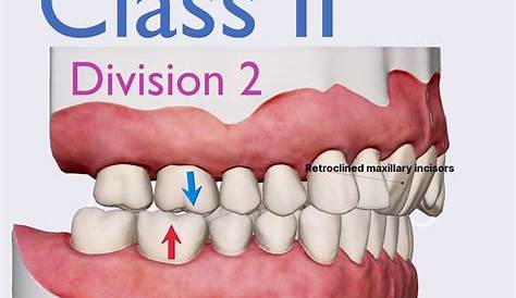 dentalaka: Management of Class II Division 1 Malocclusion PPT and Videos