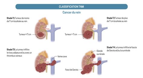 classification du cancer du rein