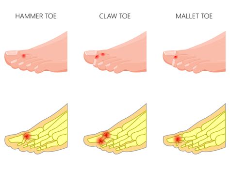 Claw Toe Vs Mallet Toe