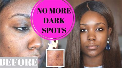 clear black spots on black skin