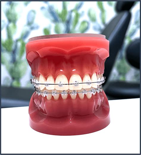 Clear Braces El Paso