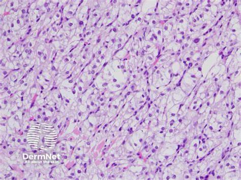 Pathology Outlines Clear cell carcinoma