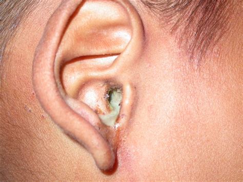 Clear Ear Discharge