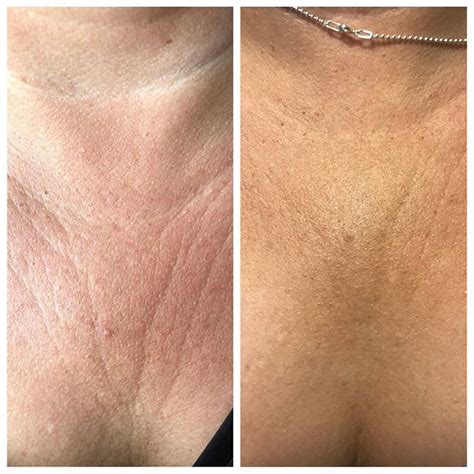 Cleavage Wrinkle Treatment: Tips And Tricks In 2023